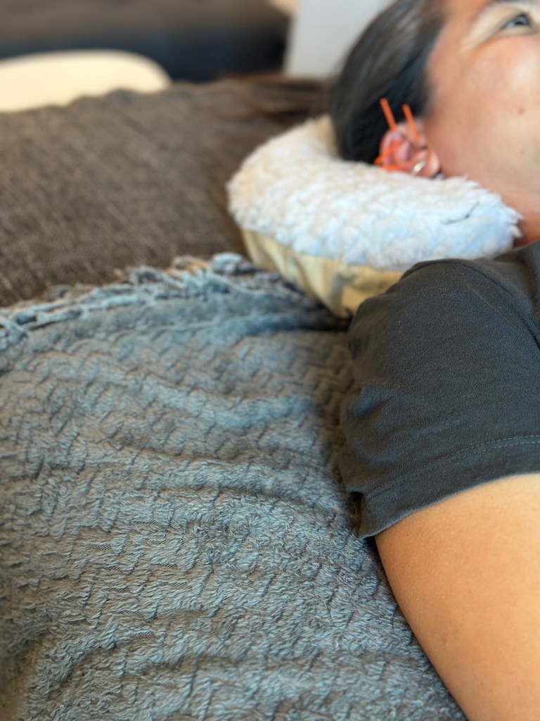 acupuncture ear 👂 treatment