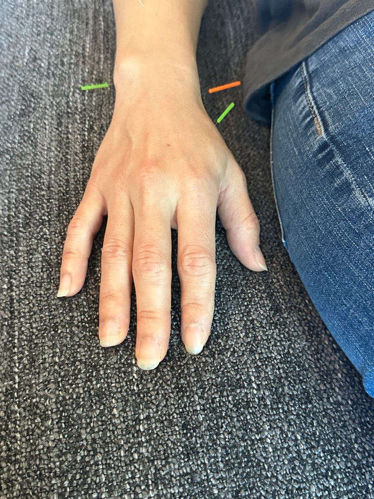 acupuncture hand 🤚 treatment