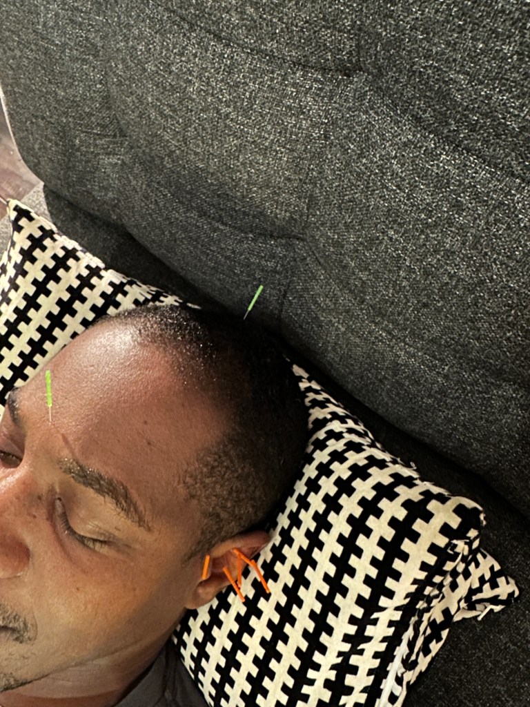 acupuncture stress 😌 treatment