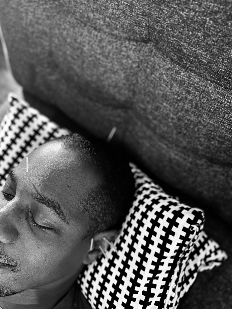 acupuncture treatment