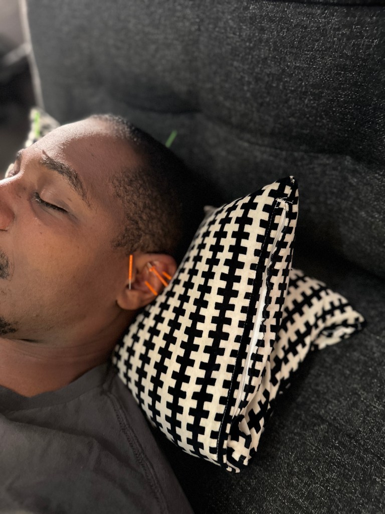 acupuncture ear 👂 and 💆‍♂️ stress treatment
