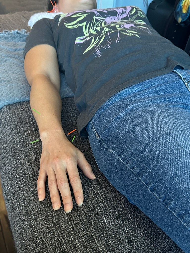 acupuncture wrist ✍🏽 treatment